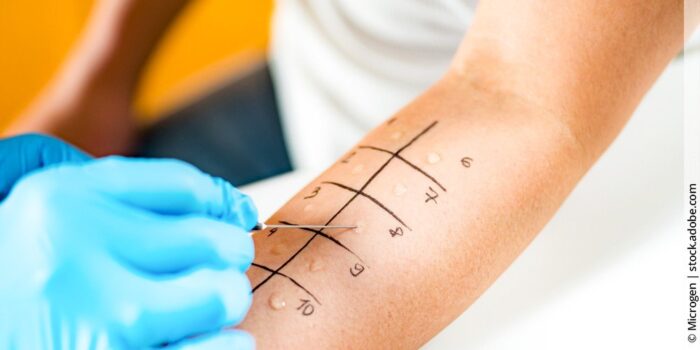 Häufige Allergien bei Hashimoto: Warum die Verbindung kein Zufall ist und was du dagegen tun kannst