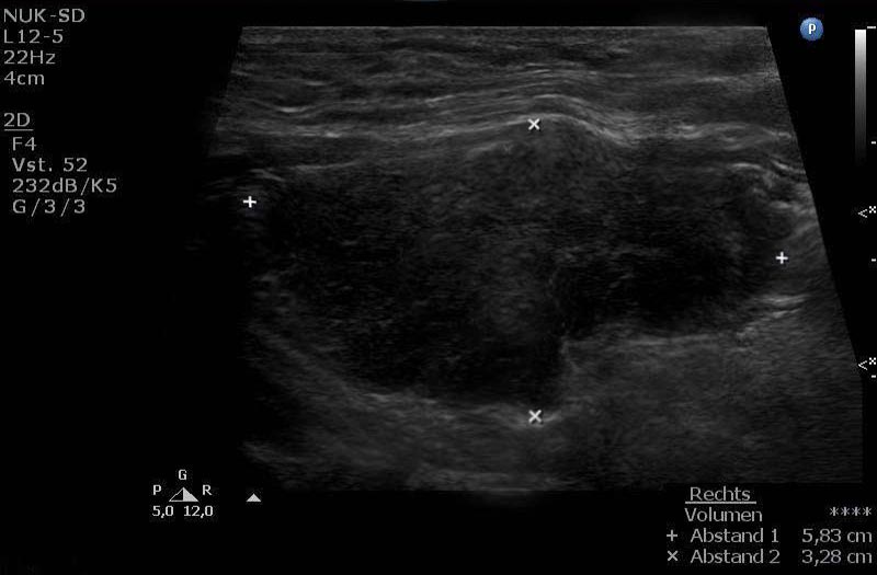 Ultraschall bei Hashimoto-Diagnose: Echoarme Schilddrüse im Ultraschall - Ein Hinweis auf Hashimoto Thyreoiditis